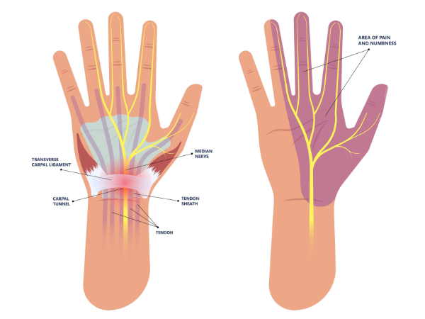 carpal-tunnel-syndrome-pain-hand-diagram-propel-physiotherapy - Propel ...