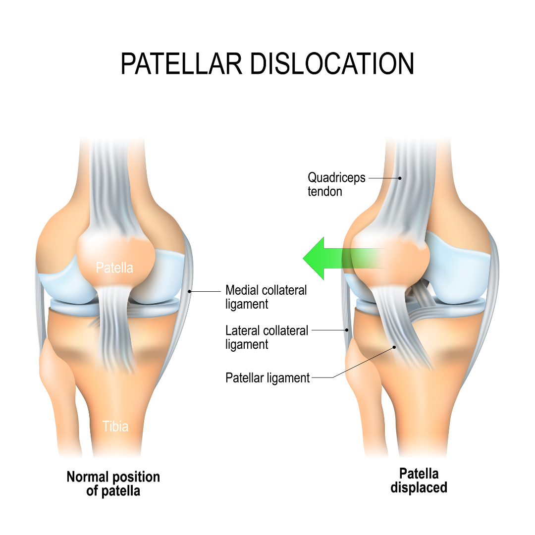 Dislocated knee deals recovery exercises