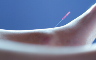 how acupuncture works propel phyiotherapy