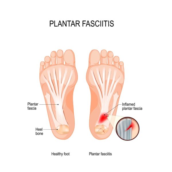 plantar fasciitis diagram inflamed plantar fascia propel physiotherapy shockwave therapy custom orthotics