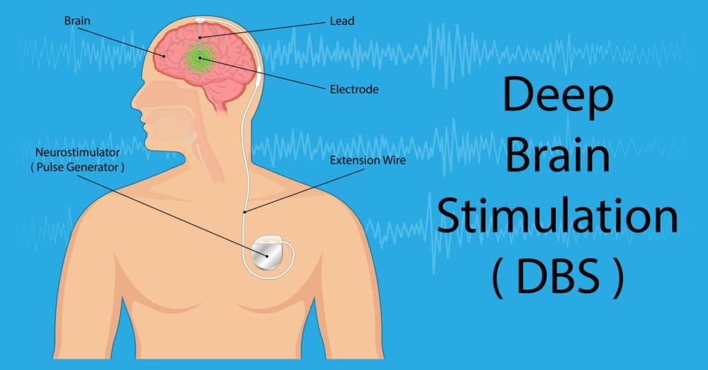 deep brain stimulation DBS dystonia treatment Propel Physiotherapy