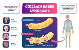 guillain barre syndrome treatment propel physiotherapy