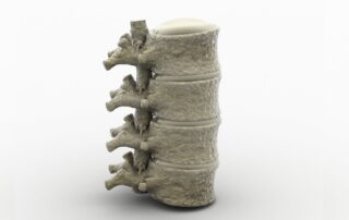transverse myelitis spinal cord section propel physiotherapy