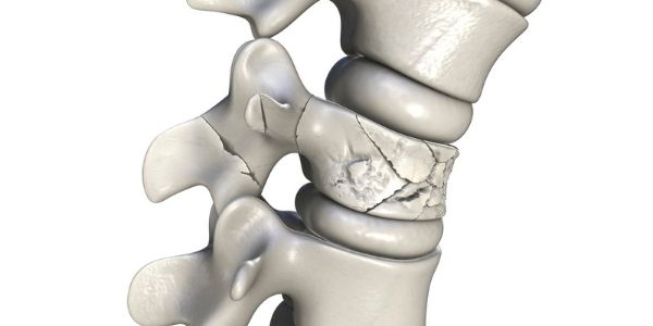 Spinal Compression Fractures: Symptoms, Causes, and Treatment