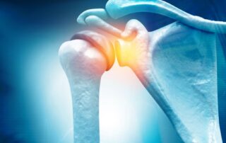 frozen shoulder physiotherapy treatment Propel Physiotherapy