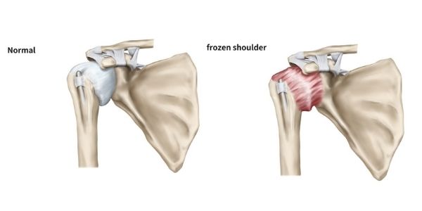frozen shoulder vs healthy shoulder Propel Physiotherapy