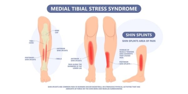 shin splints physiotherapy medial tibial stress syndrome rehabilitation Propel Physiotherapy