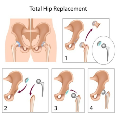 total hip replacement surgery 