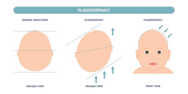 plagiocephaly diagram torticollis complication Propel Physiotherapy