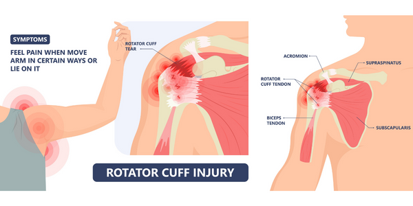 Rotator cuff tear injury treatment Propel Physiotherapy