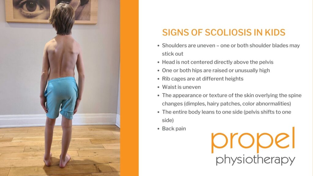 Signs of scoliosis in kids. Propel Physiotherapy provides pediatric scoliosis treatment.