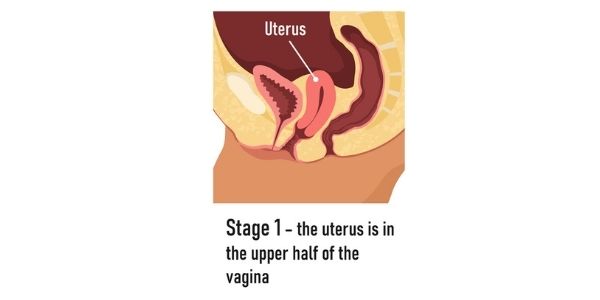 stage 1 prolapsed uterus diagram uterine prolapsetreatment Propel Physiotherapy