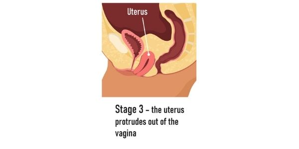 stage 3 prolapsed uterus diagram uterine prolapsetreatment Propel Physiotherapy