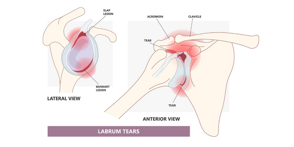 labral tears shoulder treatment Propel Physiotherapy
