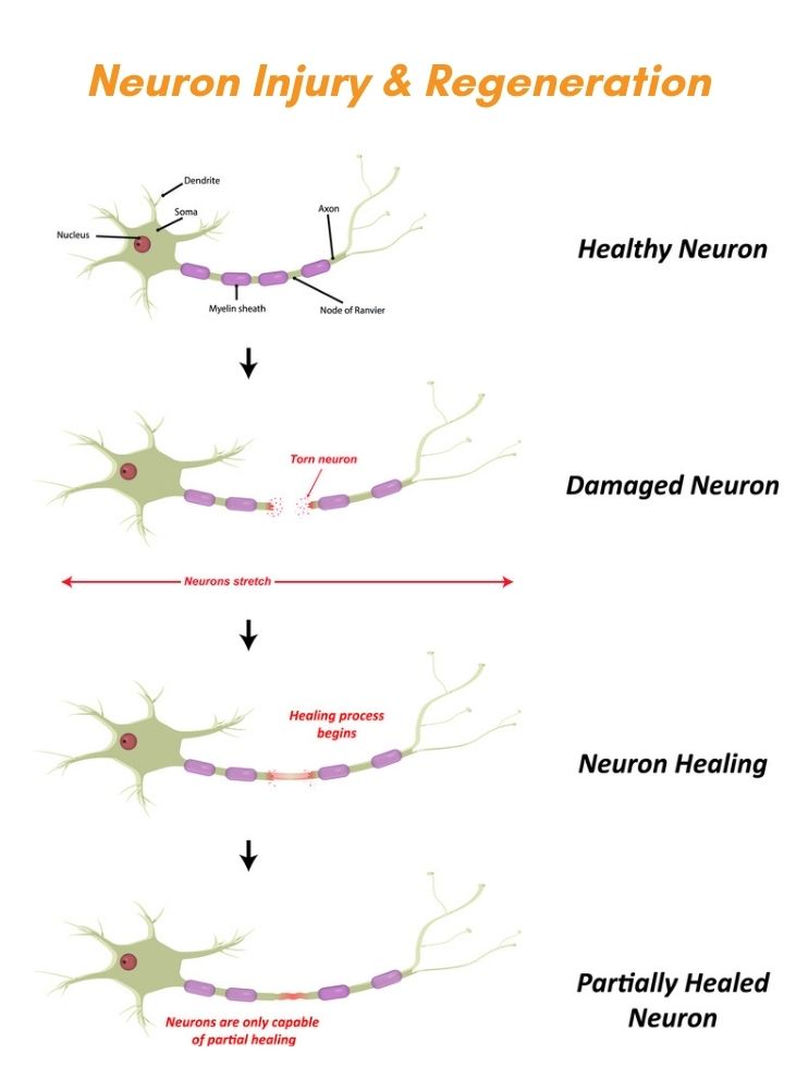 Neuron injury regeneration. Peripheral nerve injury treatment Propel Physiotherapy.