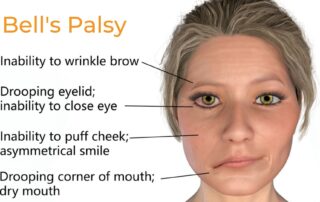 Bell's palsy treatment and symptoms Propel Physiotherapy