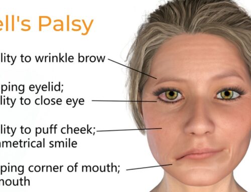 Bell’s Palsy Treatment