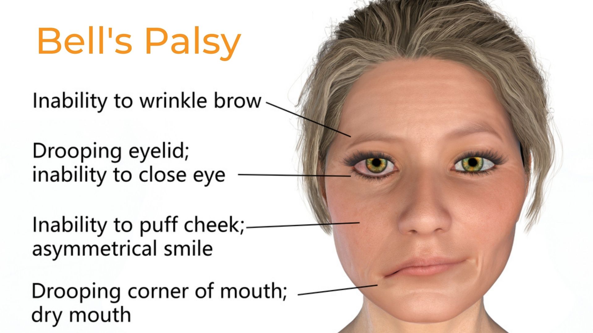 Bell's palsy treatment and symptoms Propel Physiotherapy