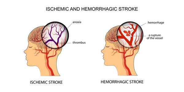 Ischemic and hemorrhagic stroke rehabilitation Propel Physiotherapy
