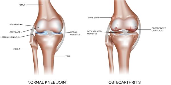 Normal knee compared to osteoarthritic knee. Knee osteoarthritis physiotherapy and knee replacement rehabilitation. Propel Physiotherapy