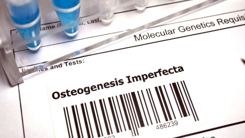 Osteogenesis Imperfecta Treatment Brittle Bone Disease 8108
