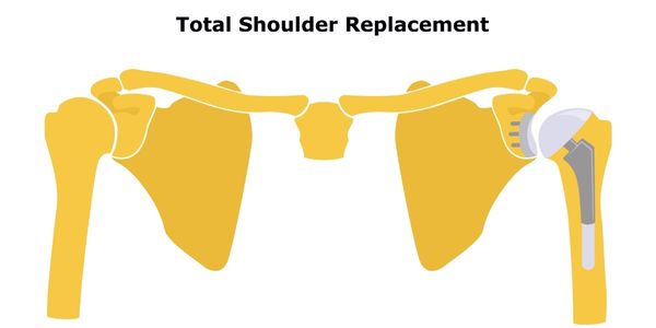total shoulder replacement physiotherapy Propel Physiotherapy