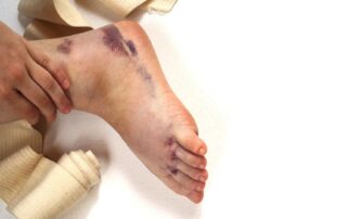 Ice pack on swollen bandaged ankle. Does ice help with inflammation? Propel Physiotherapy