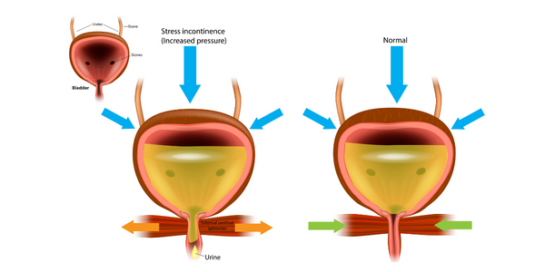 Diagram of SUI. Stress urinary incontinence treatment at Propel Physiotherapy.