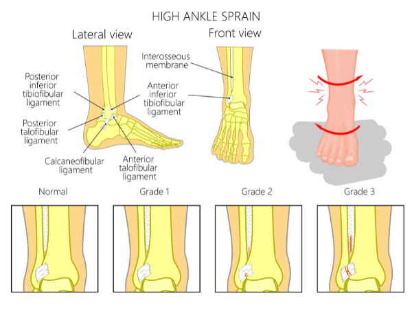 high ankle sprain lateral and front view Propel Physiotherapy