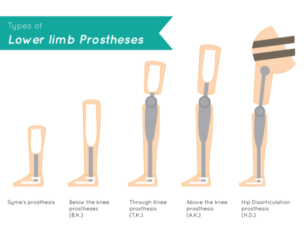 Types of leg prosthesis. Leg amputation rehabilitation Propel Physiotherapy.