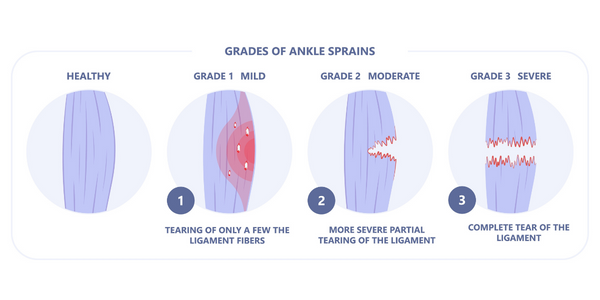 Ankle sprain classifications Propel Physiotherapy