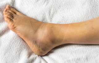 Foot with bruised swollen ankle. Ankle sprain physiotherapy Propel Physiotherapy