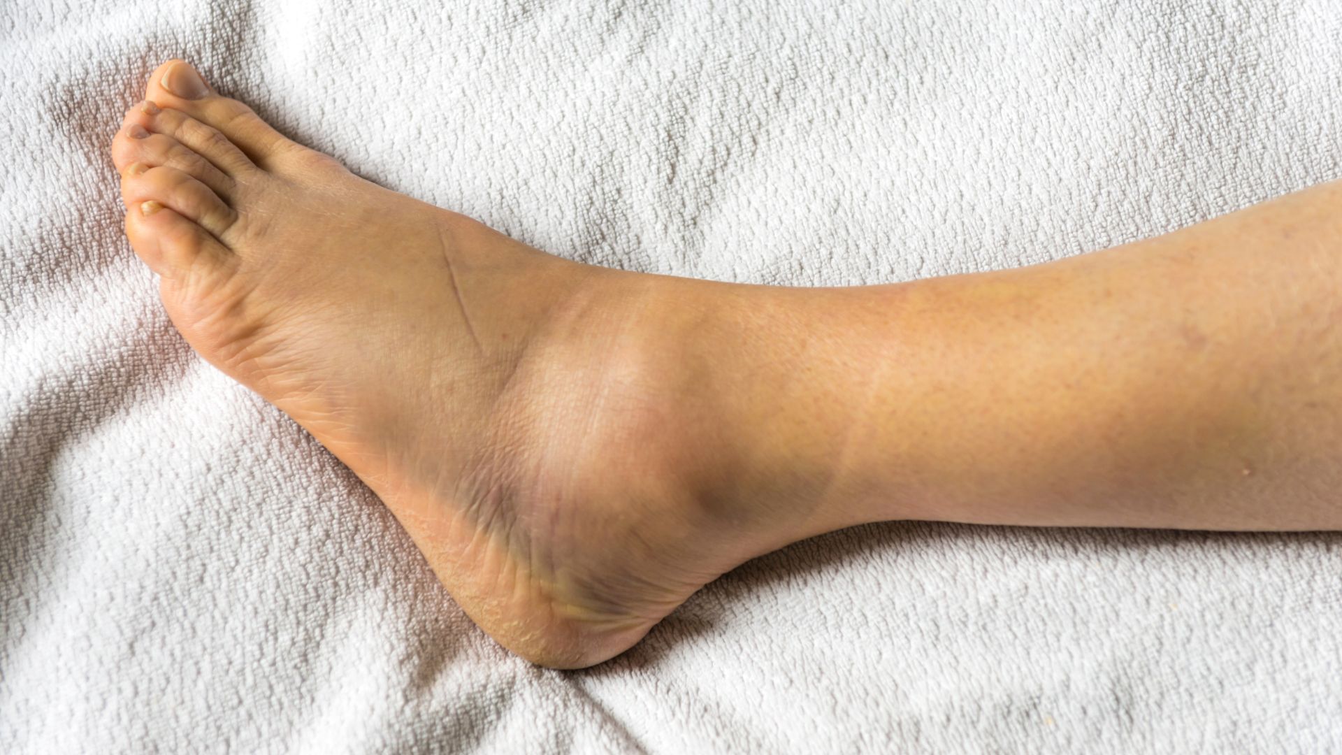Chronic Ankle Instability FAQs, Foot and Ankle