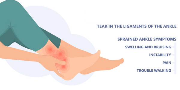 Ankle sprain symptoms. Propel Physiotherapy ankle sprain treatment.