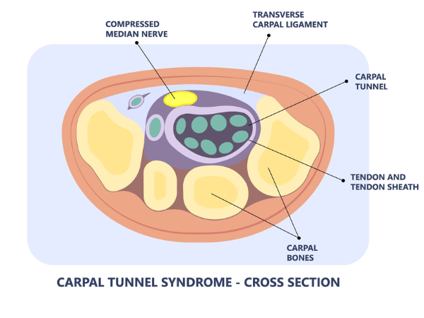 Carpal tunnel cross-section diagram. Propel Physiotherapy carpal tunnel syndrome treatment.