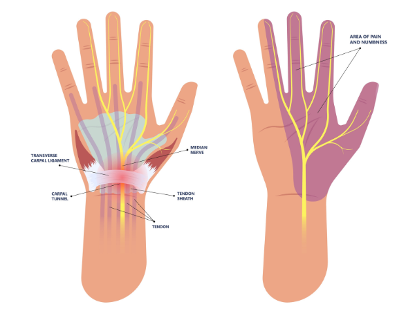 Carpal tunnel nerve compression. Propel Physiotherapy carpal tunnel syndrome treatment.