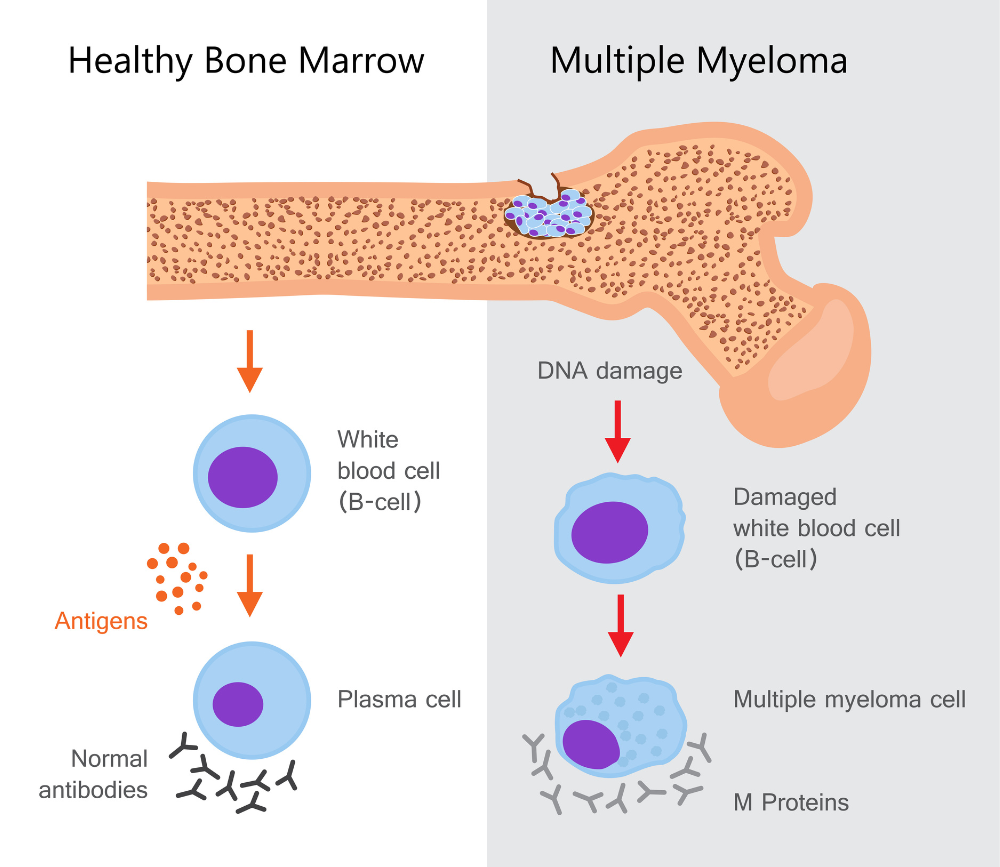 Comparison of healthy bone marrow vs bone marrow with multiple myeloma. Physiotherapy for multiple myeloma treatment Propel Physiotherapy.