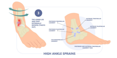 Ankle Sprain Physiotherapy Propel Physiotherapy
