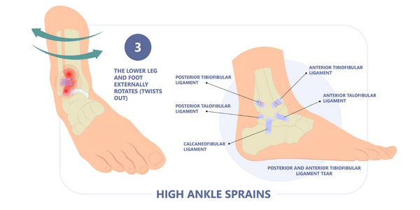 high ankle sprain types of ankle sprain physiotherapy Propel Physiotherapy