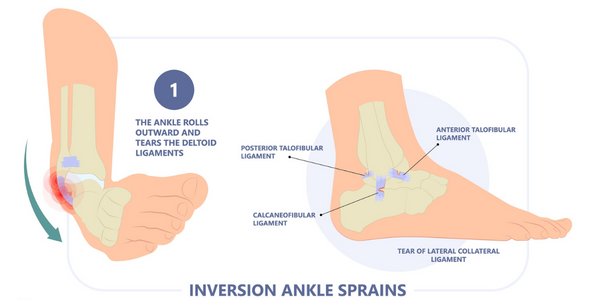 Inversion ankle sprain physiotherapy Propel Physiotherapy