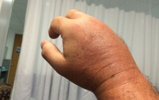 Red and swollen hand of man in hospital. Complex regional pain syndrome CRPS treatment Propel Physiotherapy