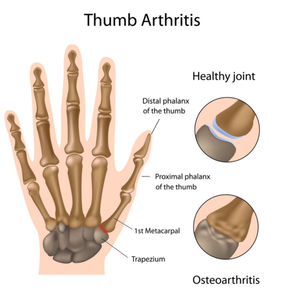 Thumb arthritis diagram. Thumb osteoarthritis treatment Propel Physiotherapy.