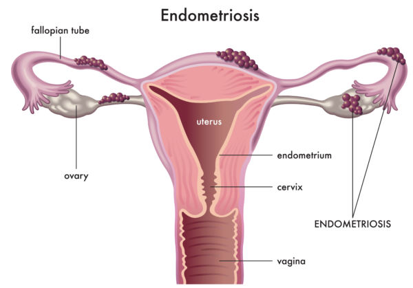 Diagram of uterus with endometriosis. pelvic floor physiotherapy for endometriosis treatment Propel Physiotherapy.