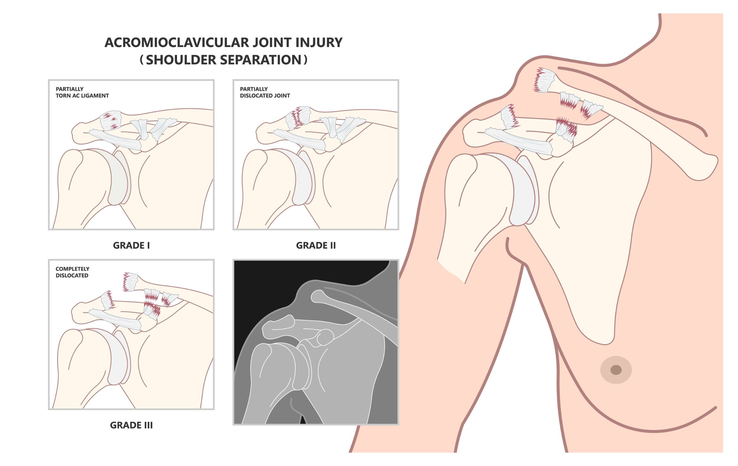 Acromioclavicular joint injury. AC joint separation treatment Propel Physiotherapy.