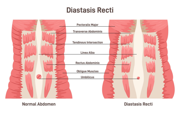 diastasis recti versus normal abdomen diagram Propel Physiotherapydiagram