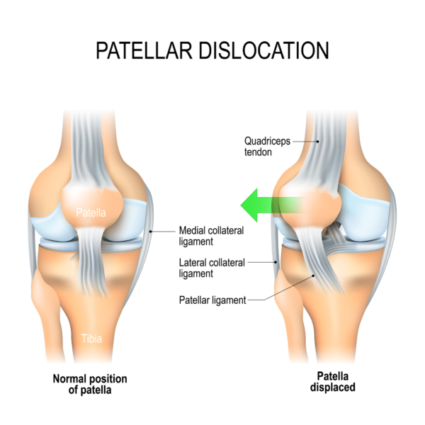Knee dislocation diagram. Knee dislocation treatment Propel Physiotherapy.