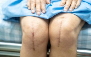 Woman in recovery after orthopedic surgery - total knee replacement - Propel Physiotherapy.