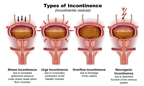 Types of incontinence. Male pelvic floor therapy at Propel Physiotherapy.