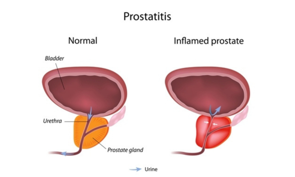 Prostatitis diagram. Male pelvic floor therapy at Propel Physiotherapy.