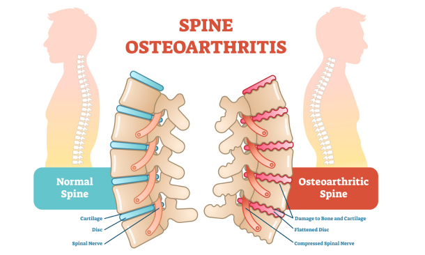 Diagram of spine osteoarthritis (spine OA). Exercise to manage Spine OA symptoms at Propel Physiotherapy. 